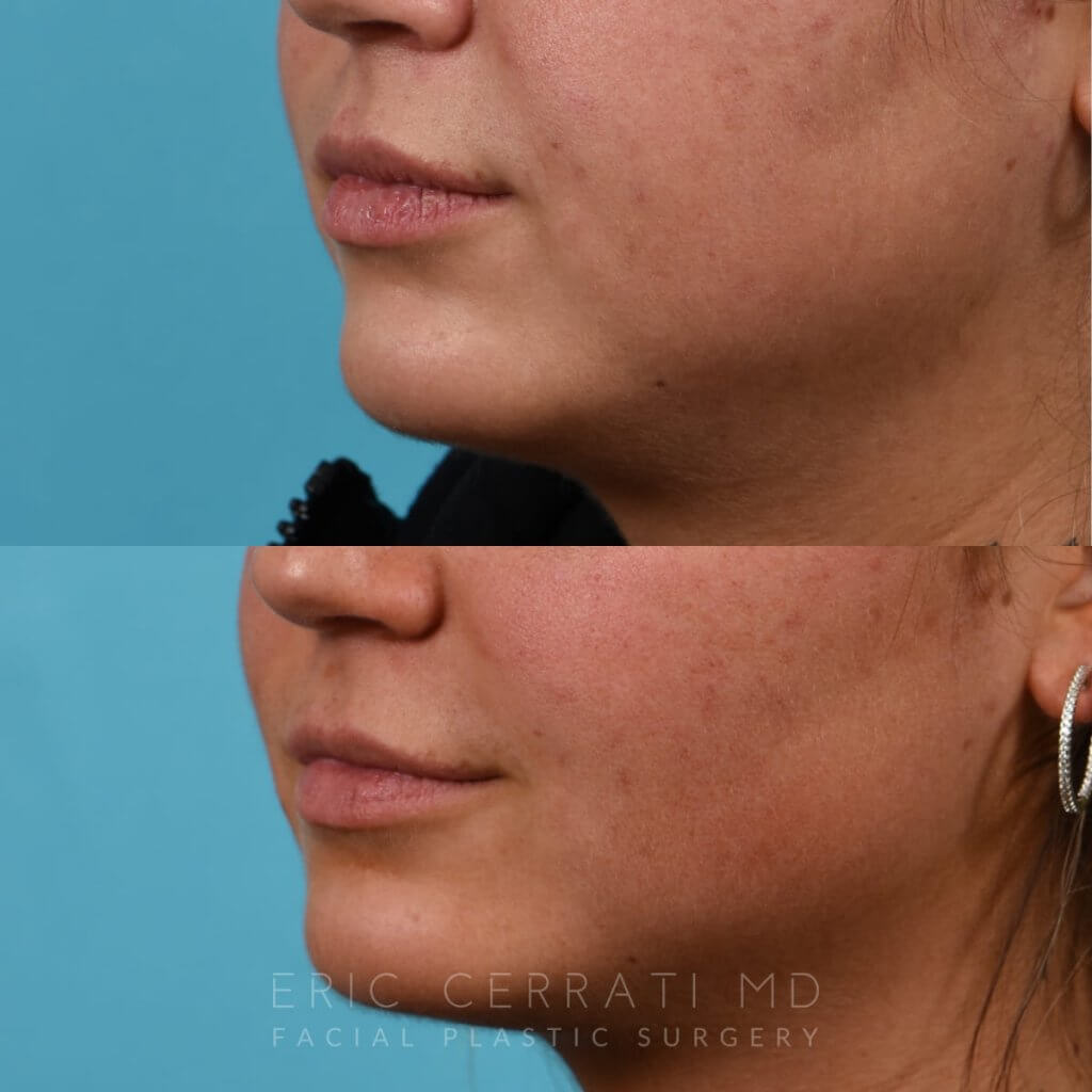 Photos of a woman's face before and after cheek reduction - from the front