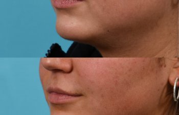 Photos of a woman's face before and after cheek reduction - from the front