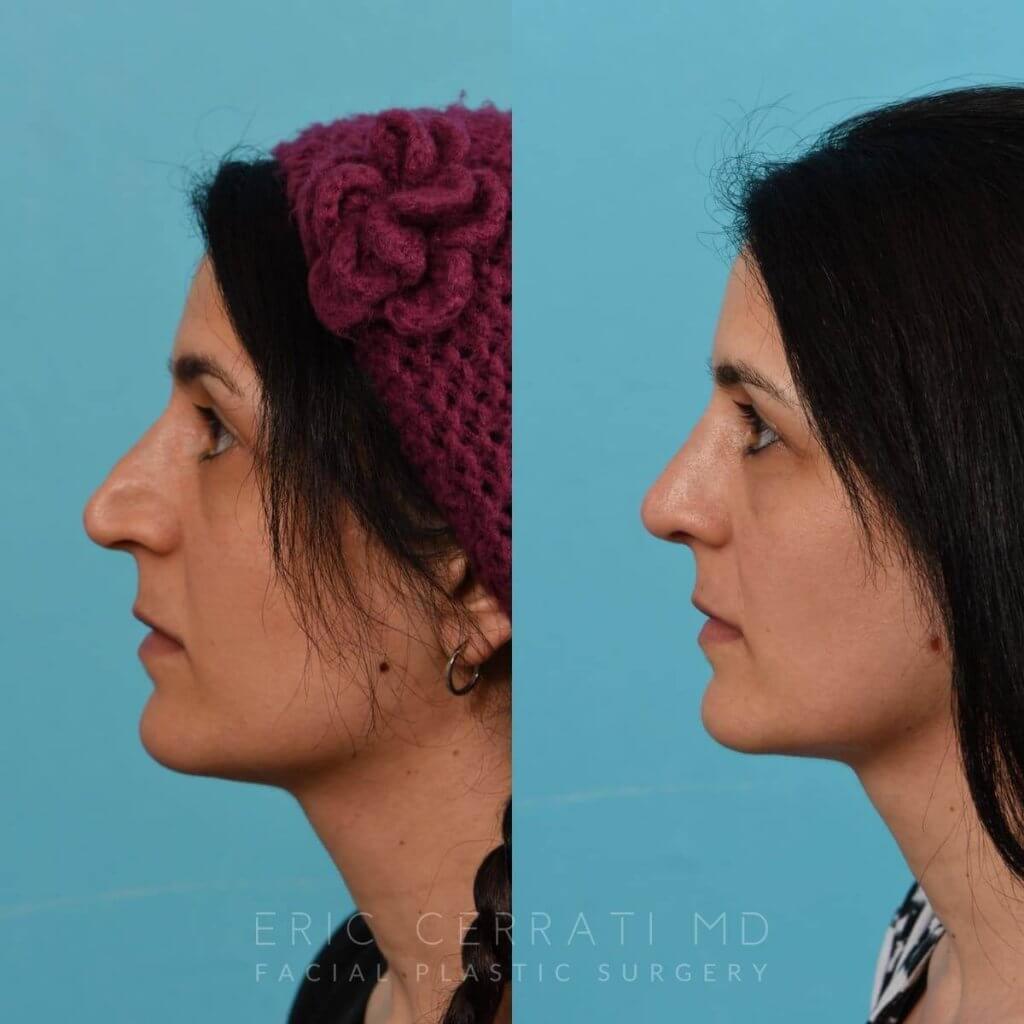 Female patient before and after rhinoplasty