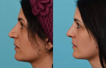 Female patient before and after rhinoplasty