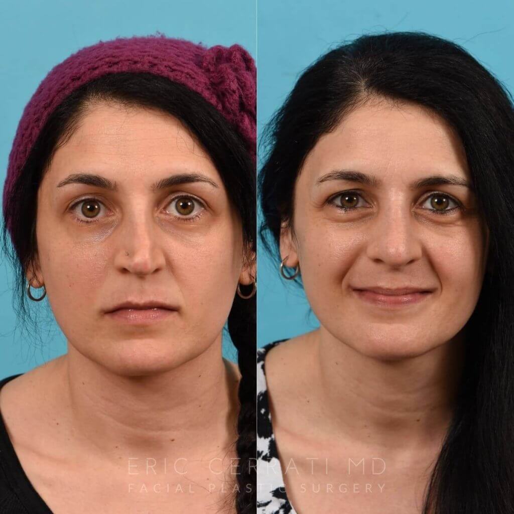 Female patient before and after rhinoplasty