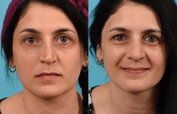 Female patient before and after rhinoplasty