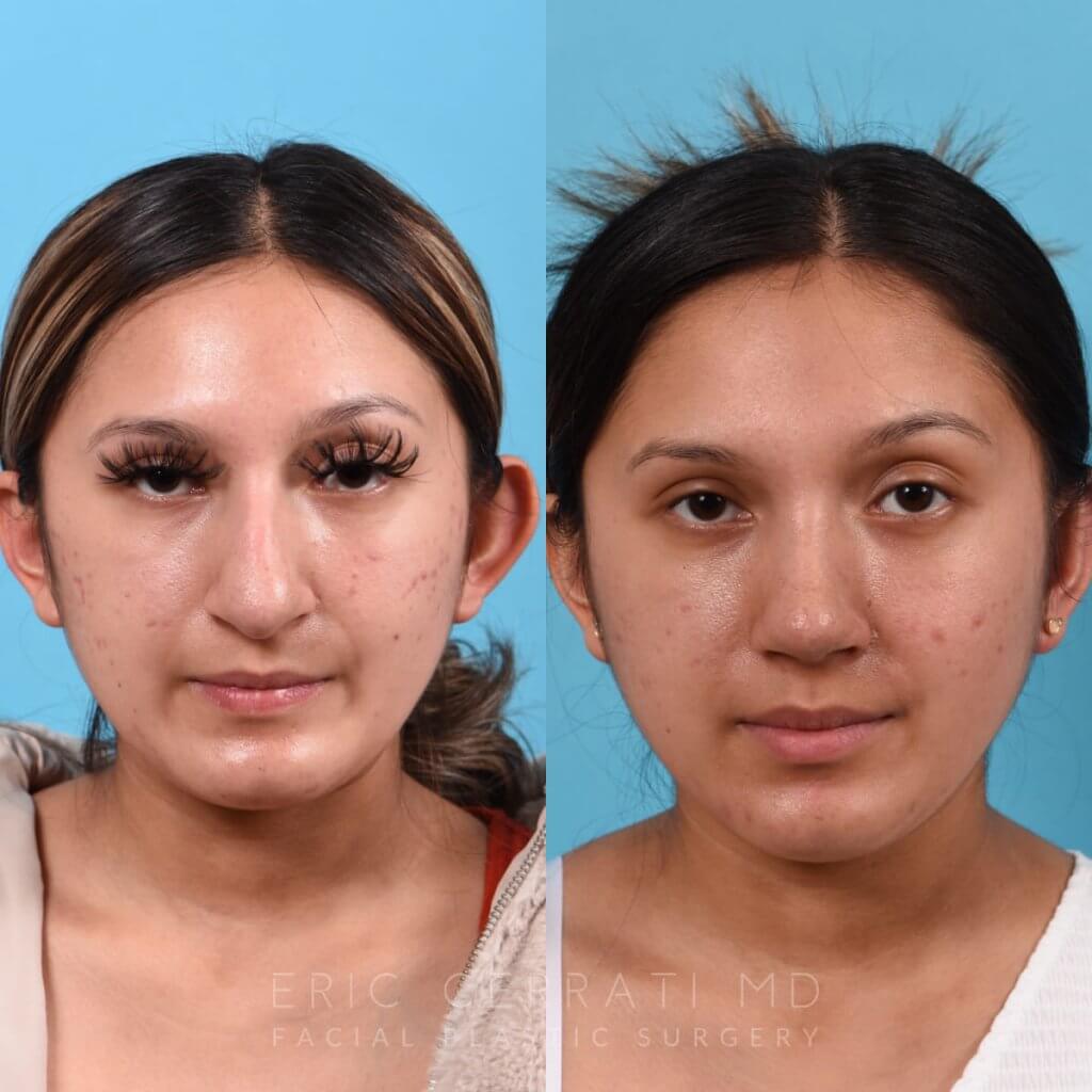 Female patient before and after rhinoplasty