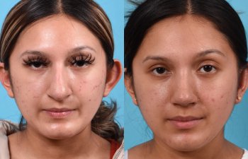 Female patient before and after rhinoplasty