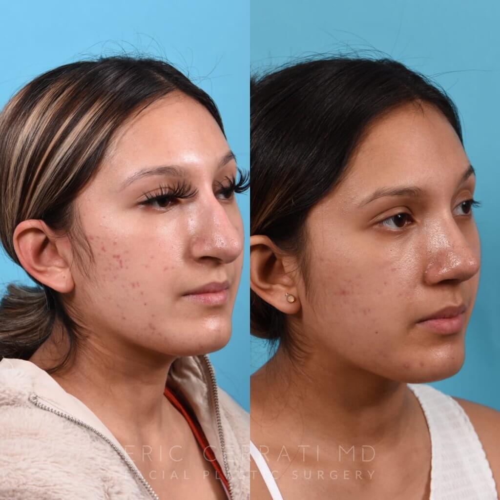 Female patient before and after rhinoplasty