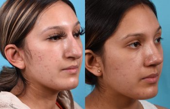 Female patient before and after rhinoplasty