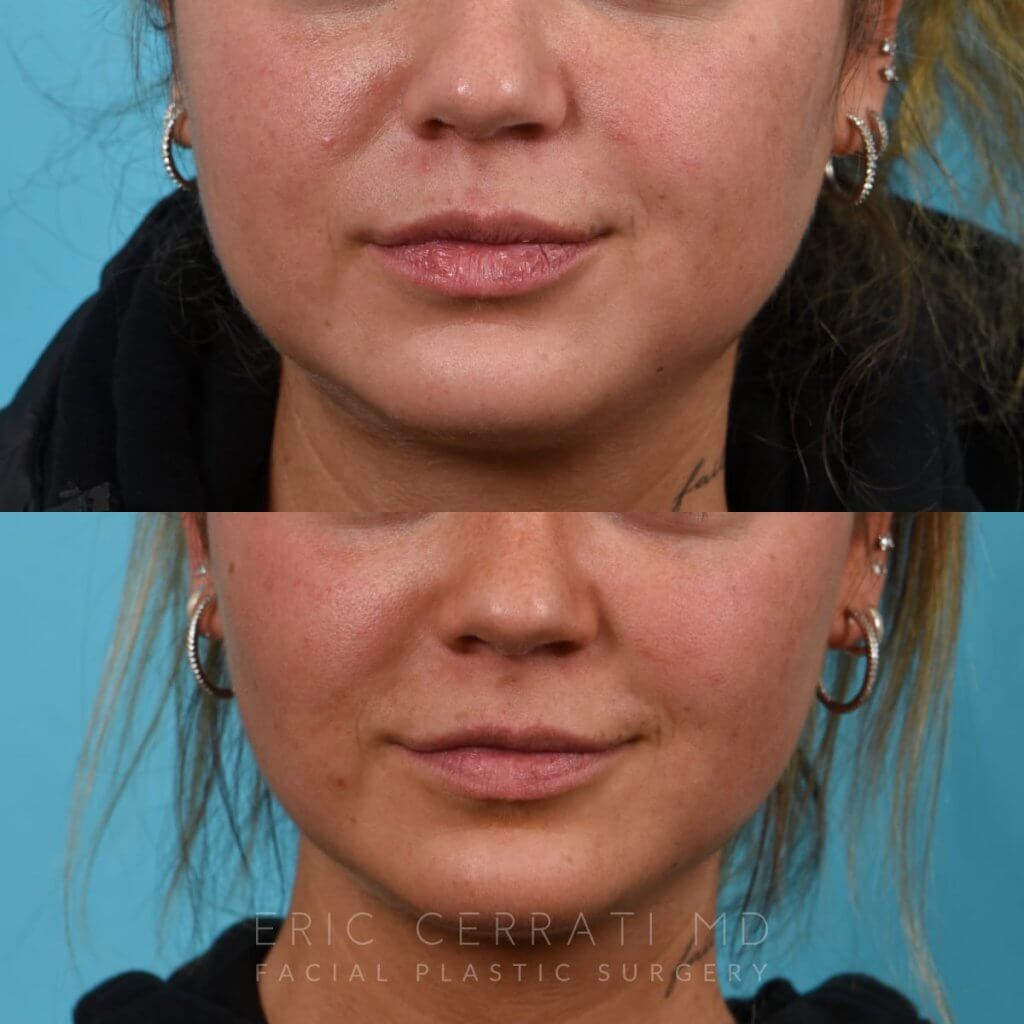 Photos of a woman's face before and after cheek reduction - from the front