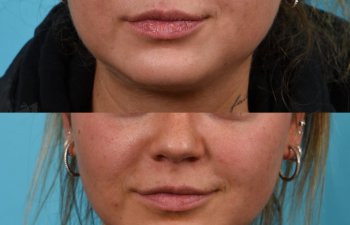 Photos of a woman's face before and after cheek reduction - from the front