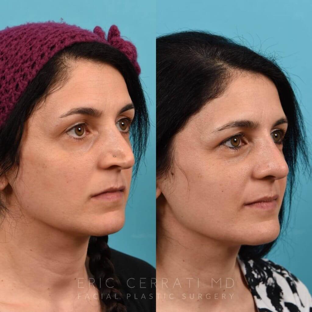 Female patient before and after rhinoplasty