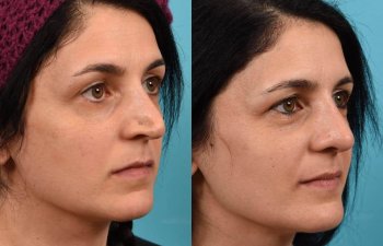 Female patient before and after rhinoplasty