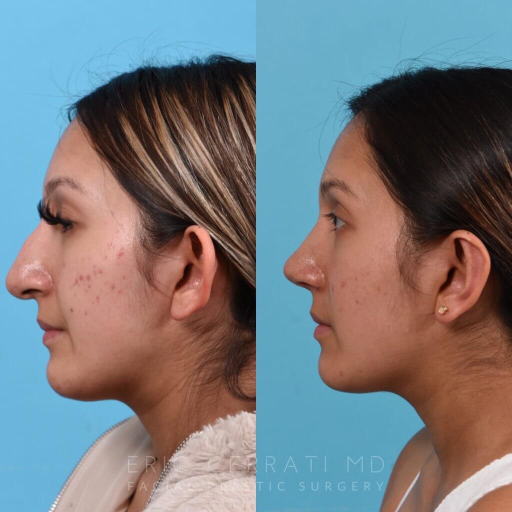 Female patient before and after rhinoplasty