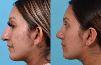 Female patient before and after rhinoplasty