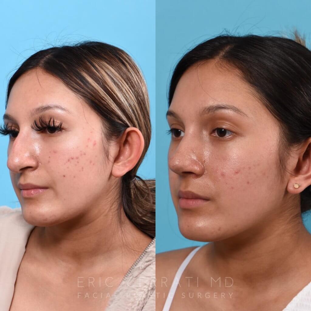 Female patient before and after rhinoplasty