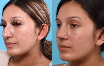 Female patient before and after rhinoplasty