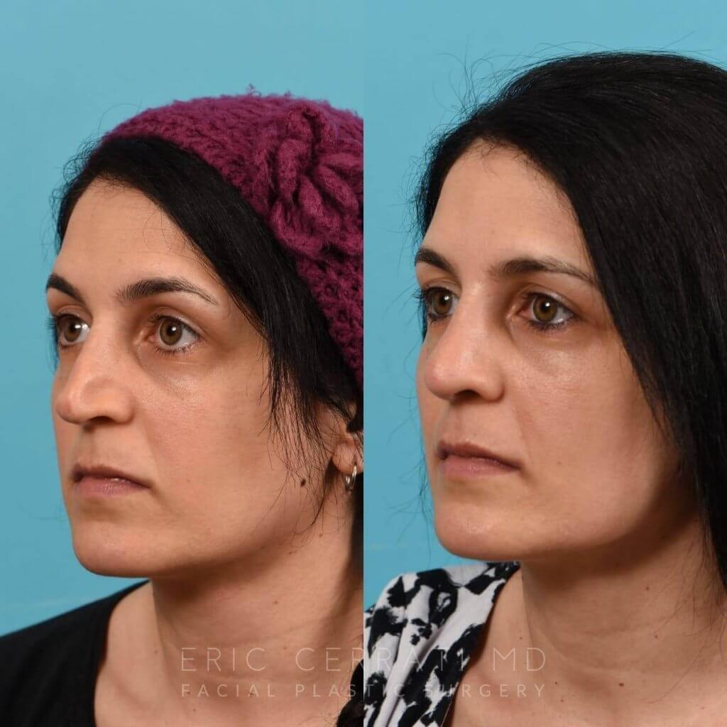 Female patient before and after rhinoplasty