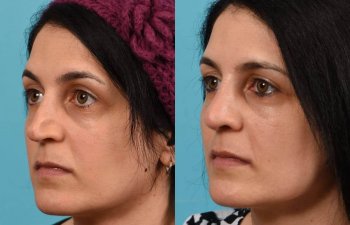 Female patient before and after rhinoplasty