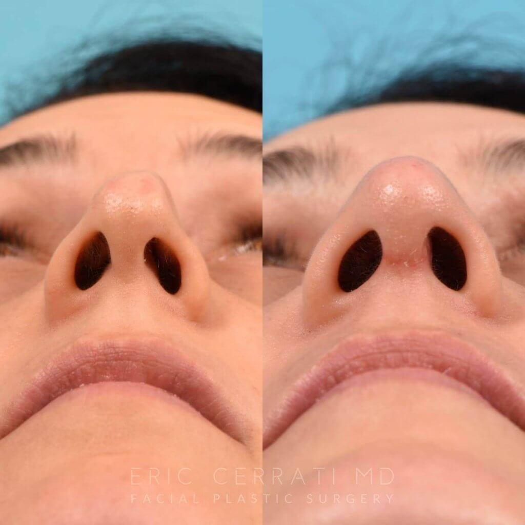Female patient before and after rhinoplasty