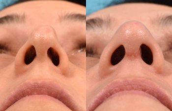 Female patient before and after rhinoplasty
