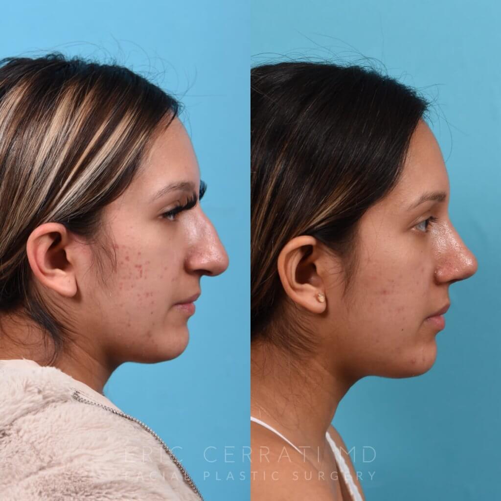 Female patient before and after rhinoplasty