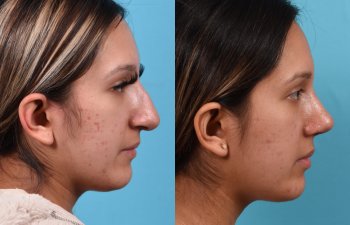 Female patient before and after rhinoplasty