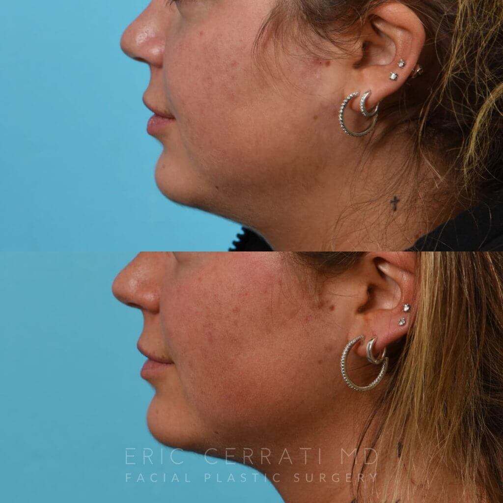 Photos of a woman's face before and after cheek reduction - from the front