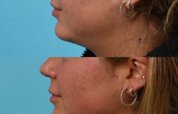 Photos of a woman's face before and after cheek reduction - from the front