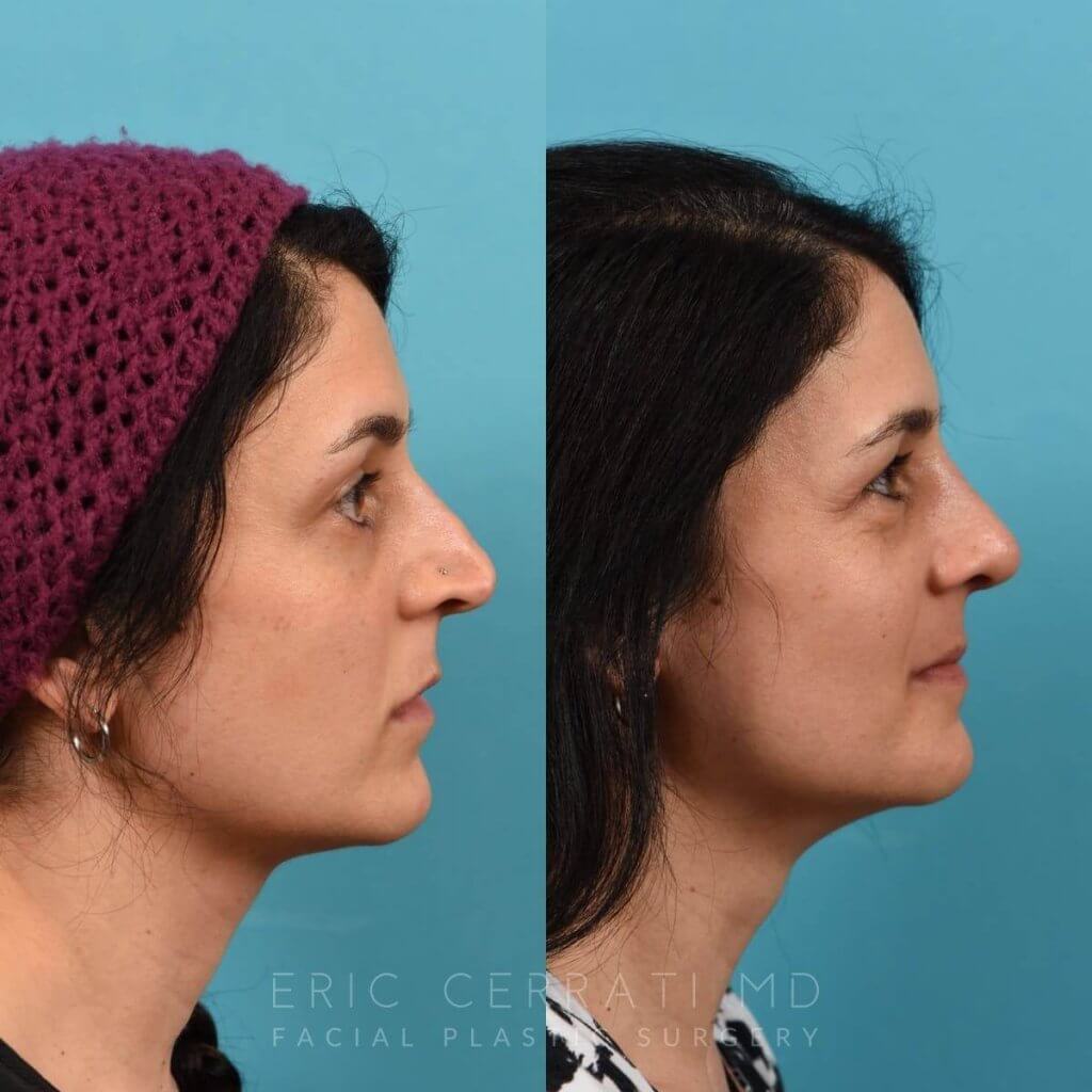 Female patient before and after rhinoplasty