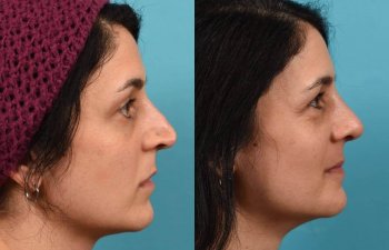 Female patient before and after rhinoplasty