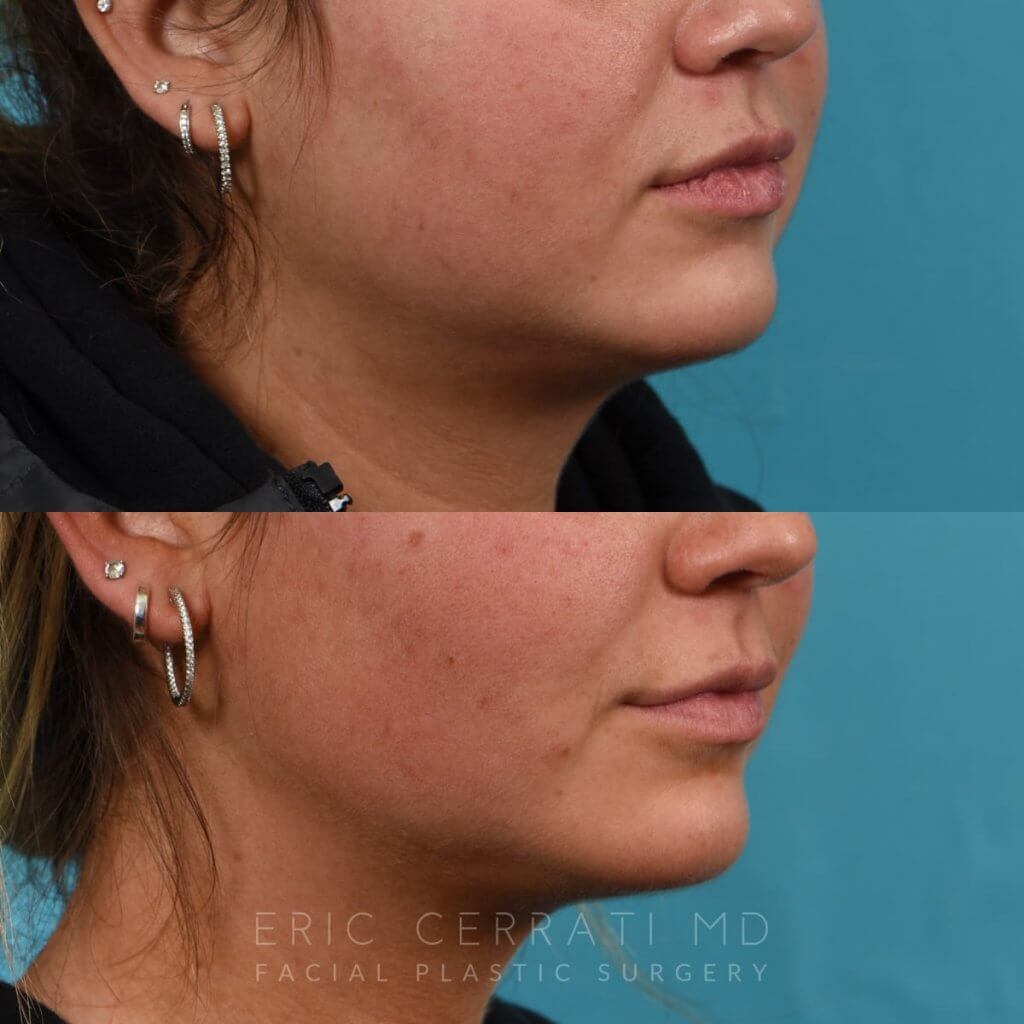 Photos of a woman's face before and after cheek reduction - from the front
