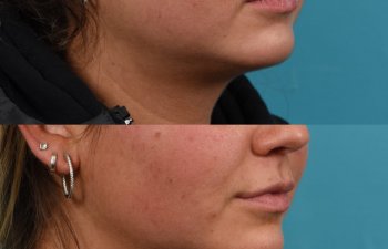 Photos of a woman's face before and after cheek reduction - from the front
