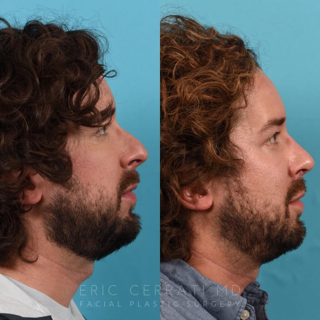 Male Patient Before and After Rhinoplasty