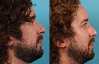 Male Patient Before and After Rhinoplasty