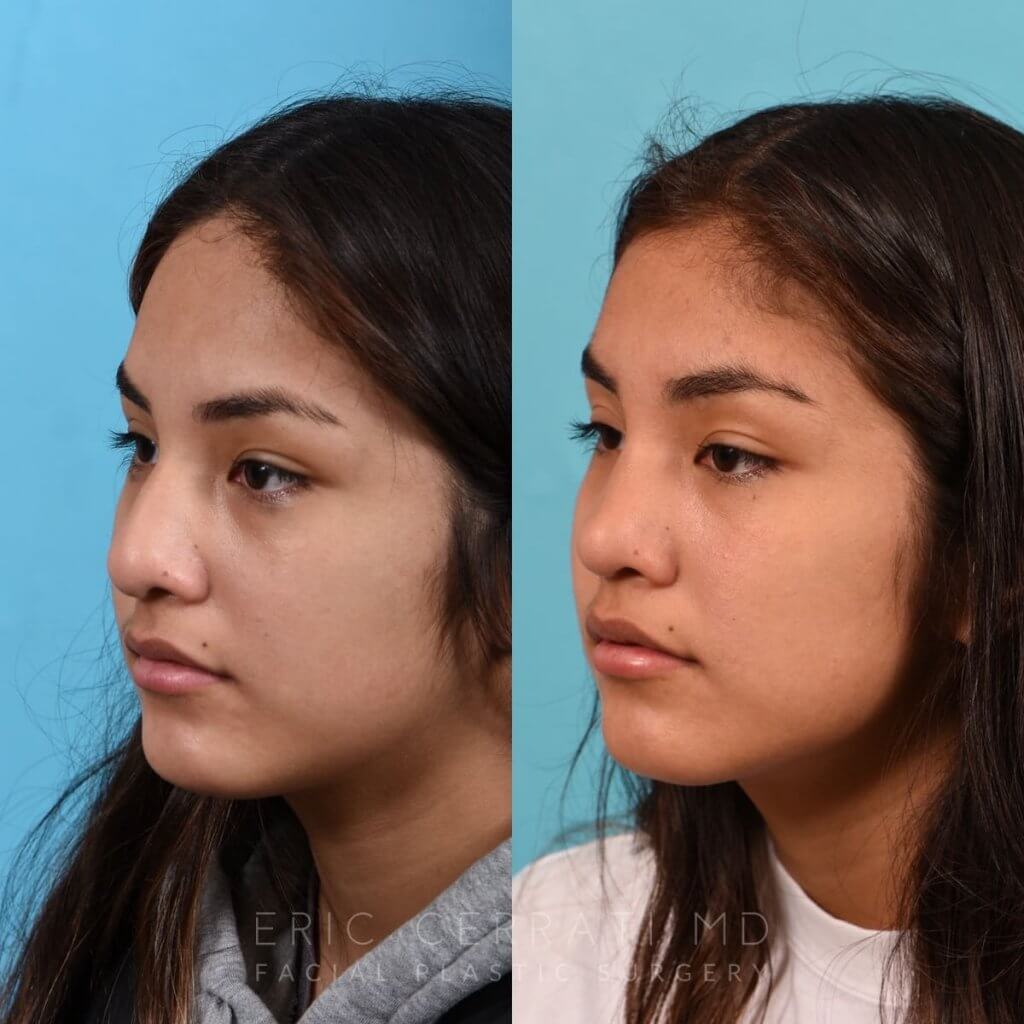 Female patient before and after rhinoplasty