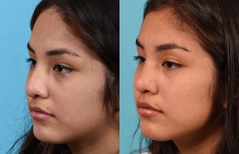 Female patient before and after rhinoplasty