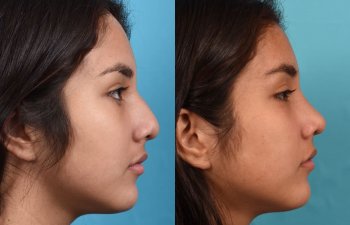 Female patient before and after rhinoplasty