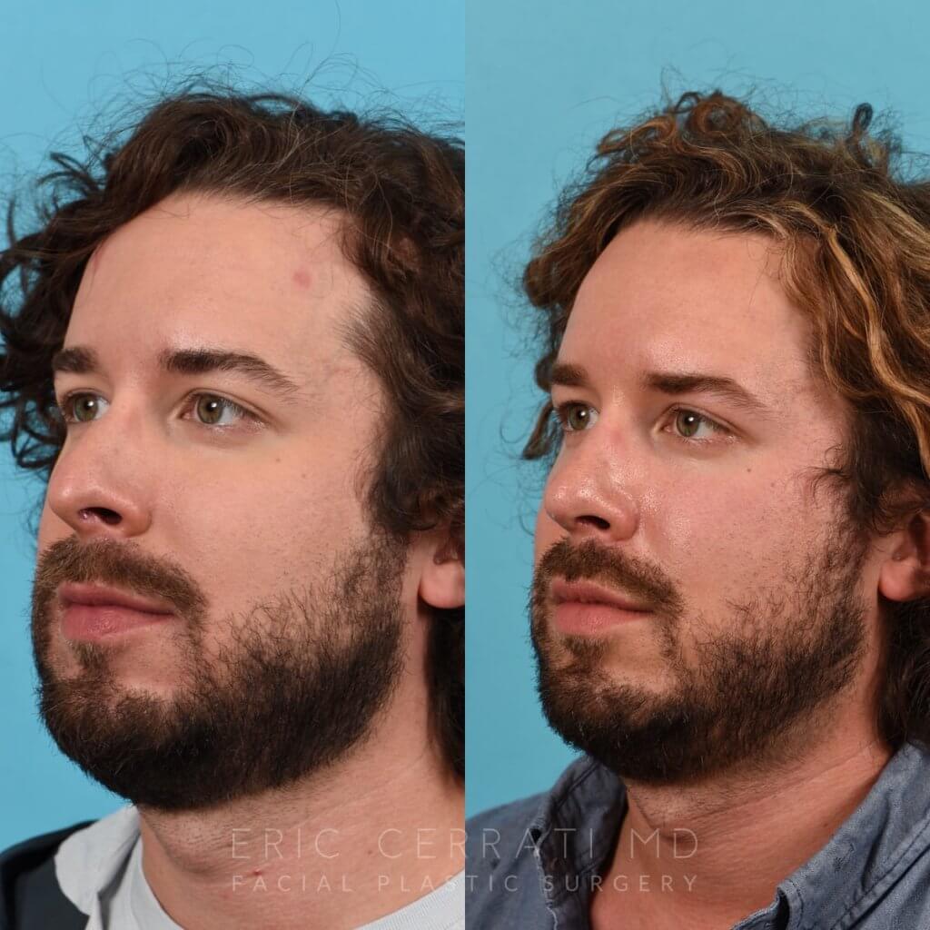 Male Patient Before and After Rhinoplasty