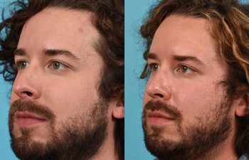 Male Patient Before and After Rhinoplasty
