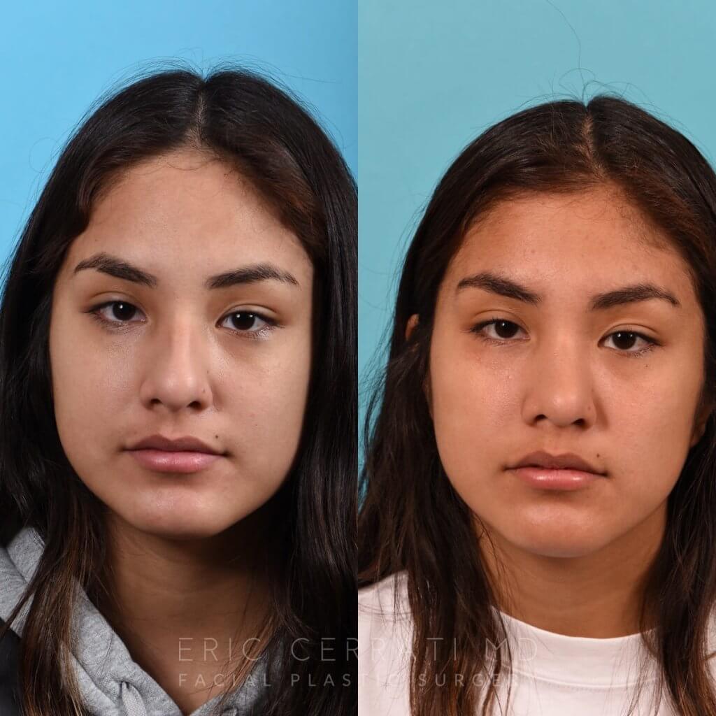 Female patient before and after rhinoplasty