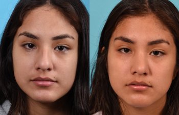 Female patient before and after rhinoplasty