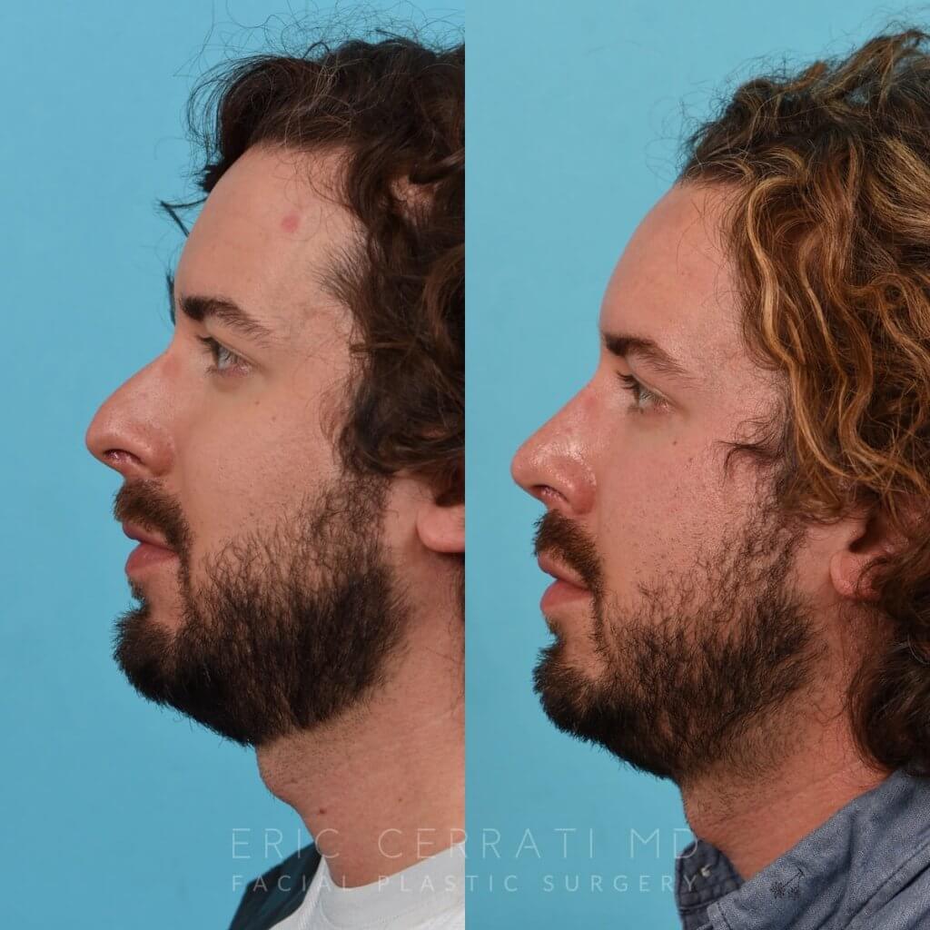 Male Patient Before and After Rhinoplasty