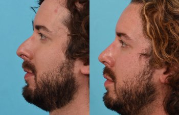 Male Patient Before and After Rhinoplasty