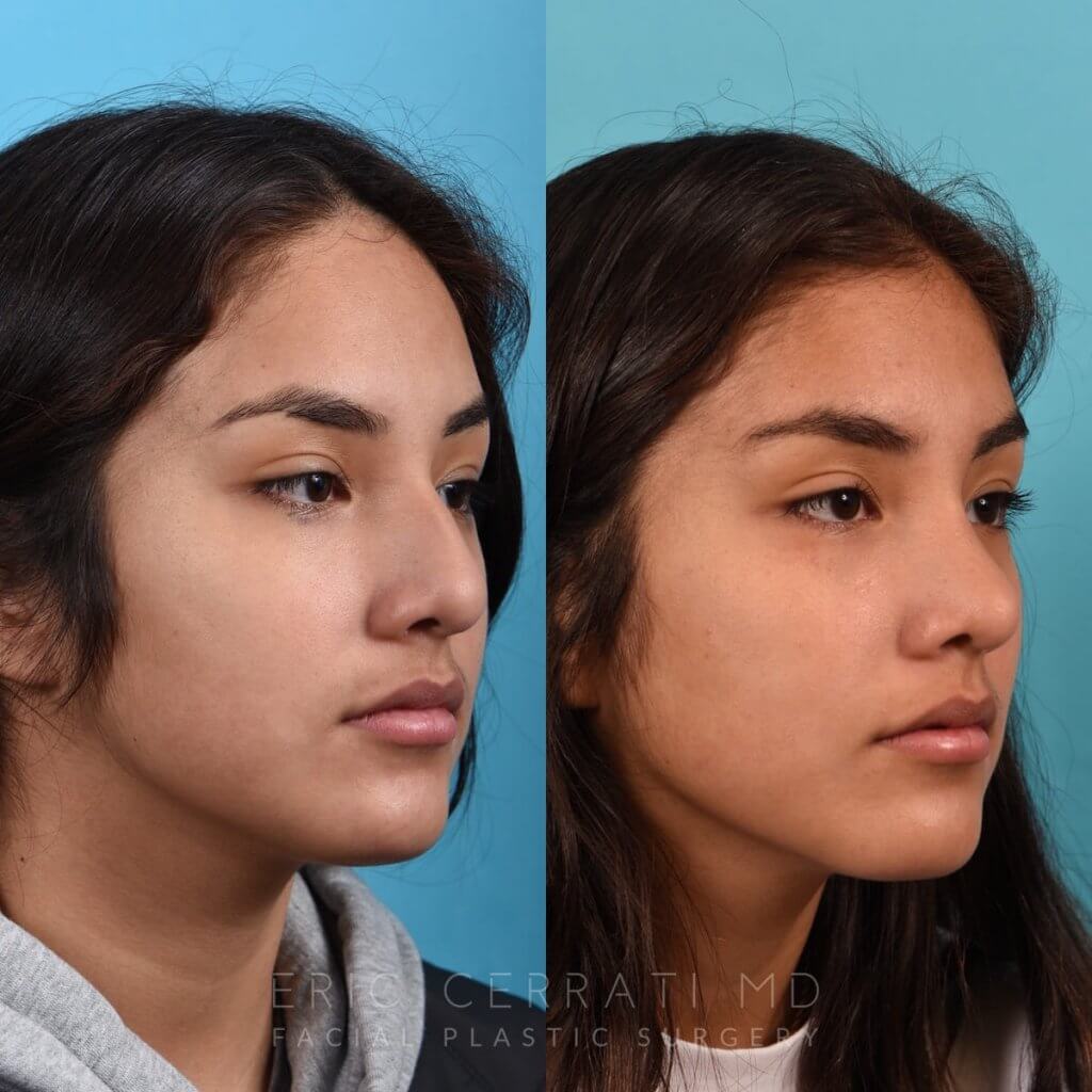 Female patient before and after rhinoplasty