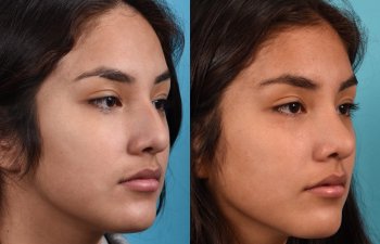 Female patient before and after rhinoplasty