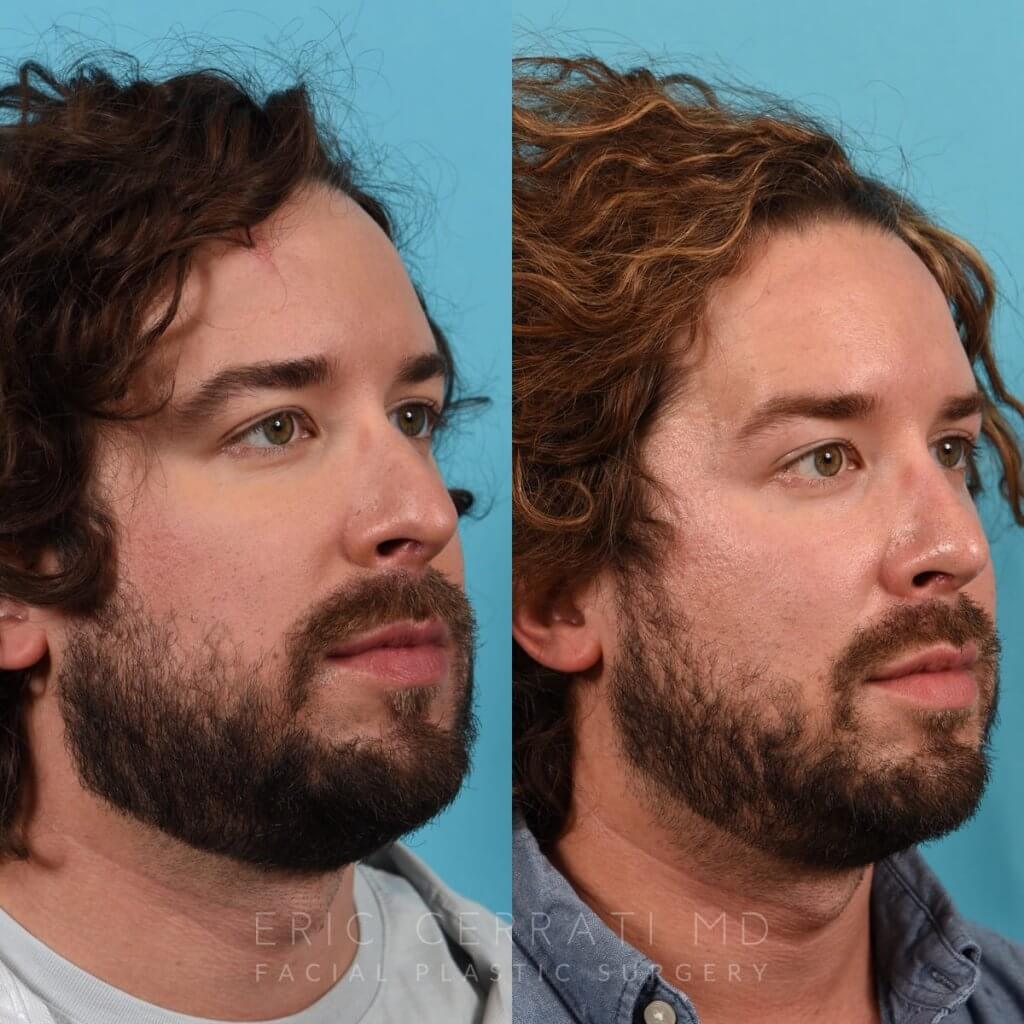 Male Patient Before and After Rhinoplasty