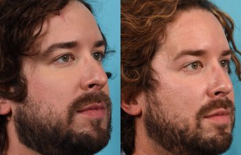 Male Patient Before and After Rhinoplasty