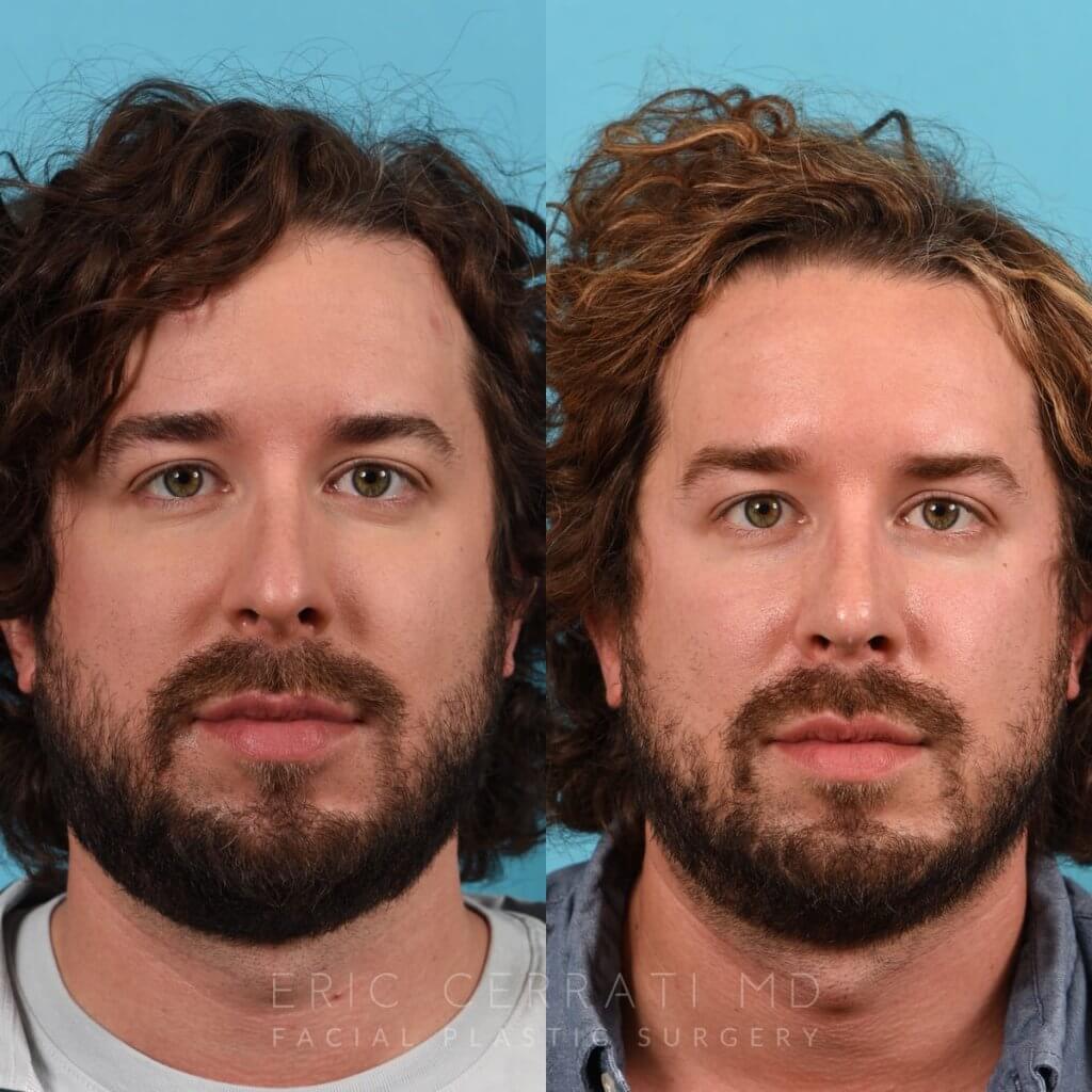 Male Patient Before and After Rhinoplasty