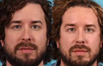 Male Patient Before and After Rhinoplasty