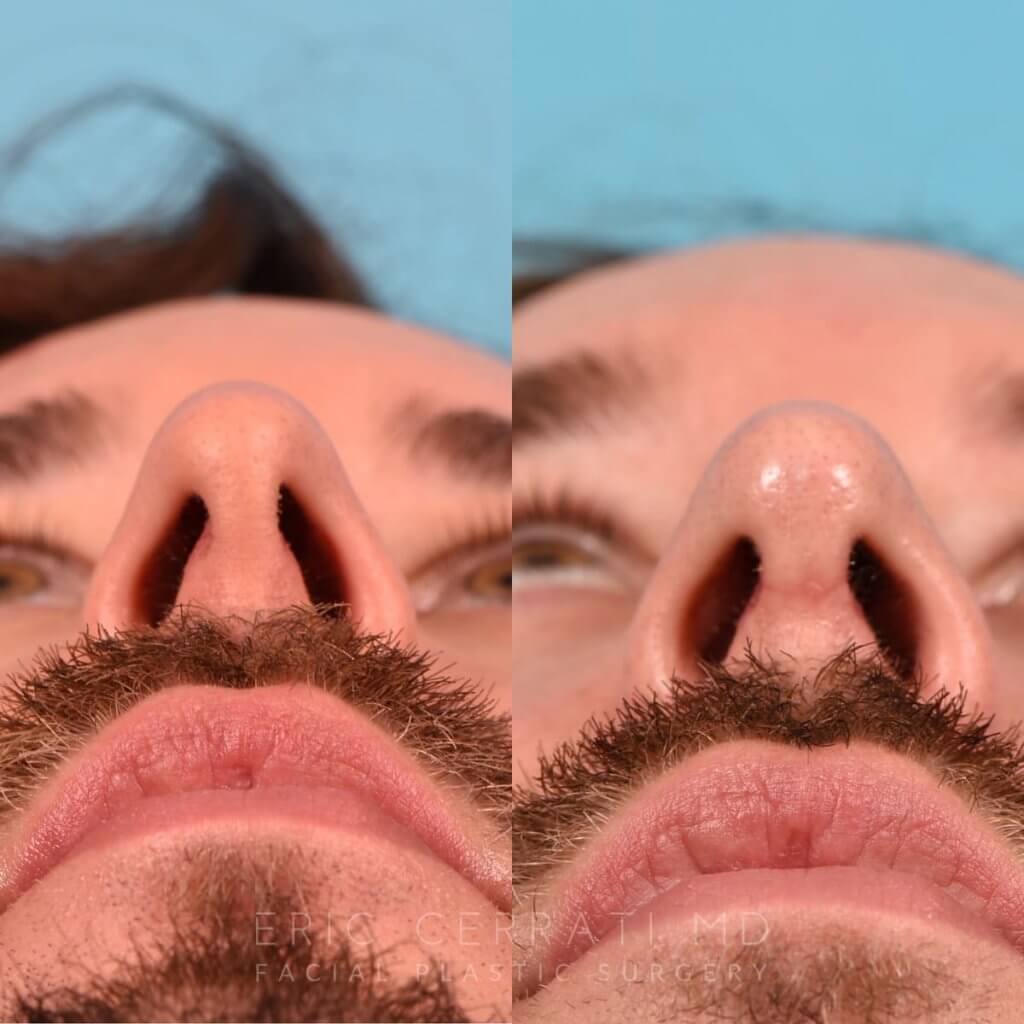 Male Patient Before and After Rhinoplasty