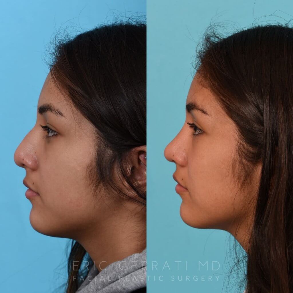 Female patient before and after rhinoplasty
