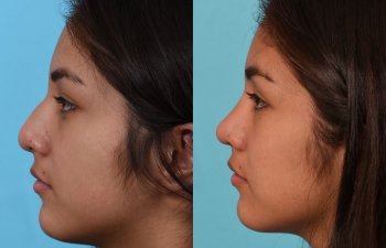 Female patient before and after rhinoplasty